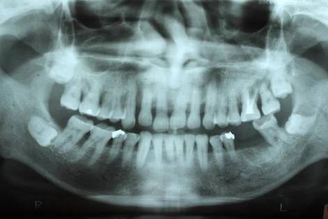 歯周病に有効な、ドイツ式入れ歯「リーゲルテレスコープ」17年経過しました