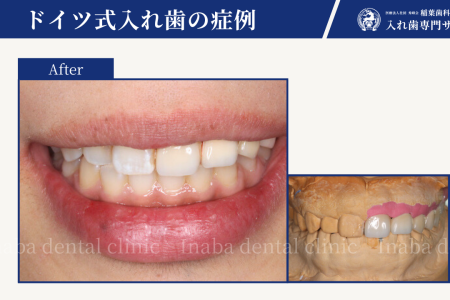 20代女性の奥歯3本の入れ歯治療〜素敵な笑顔を取り戻す方法〜