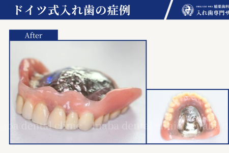 若い方の入れ歯のニーズ〜私のターニングポイントとなった症例〜