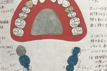 伊庭由夏先生の入れ歯治療の取り組み