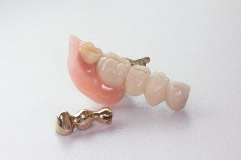 部分入れ歯　奥歯2本を失った場合の治療方法〜インプラントか入れ歯か〜