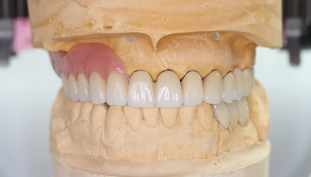 テレスコープ義歯に用いられる、コバルトクロム合金について
