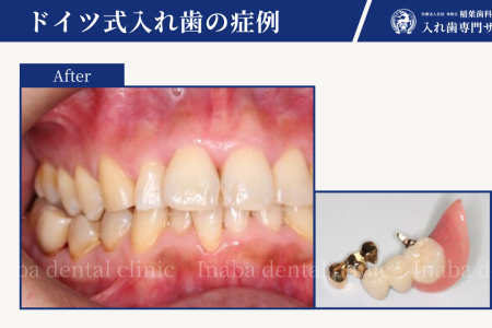 虫歯の奥歯を抜いたら、どうなるの？