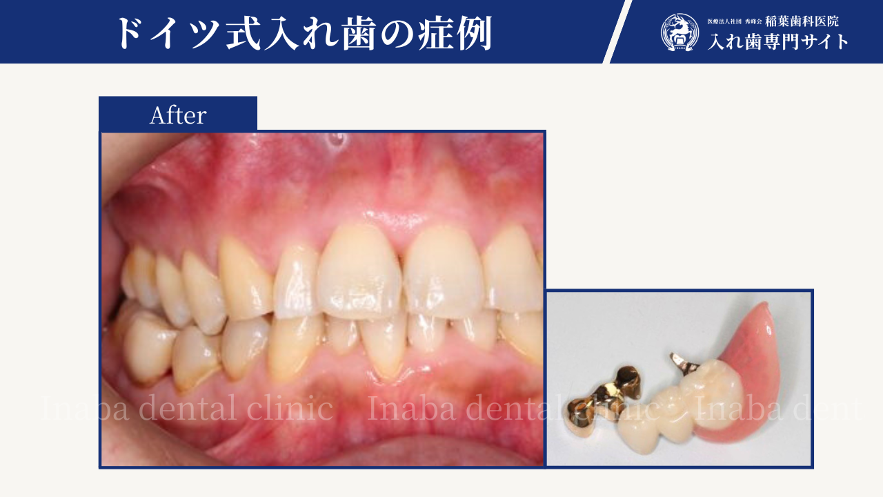 虫歯の奥歯を抜いたら、どうなるの?