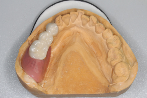 虫歯の奥歯を抜いたら、どうなるの？