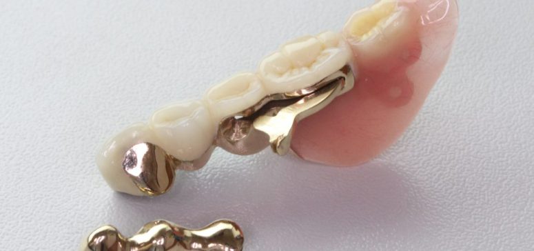テレスコープ義歯におけるコストパフォーマンス