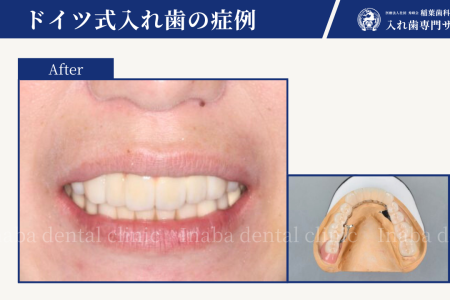 歯周病により下の前歯が抜けてしまった場合の治療方法について