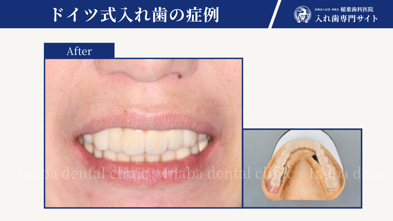 歯周病により下の前歯が抜けてしまった場合の治療方法について