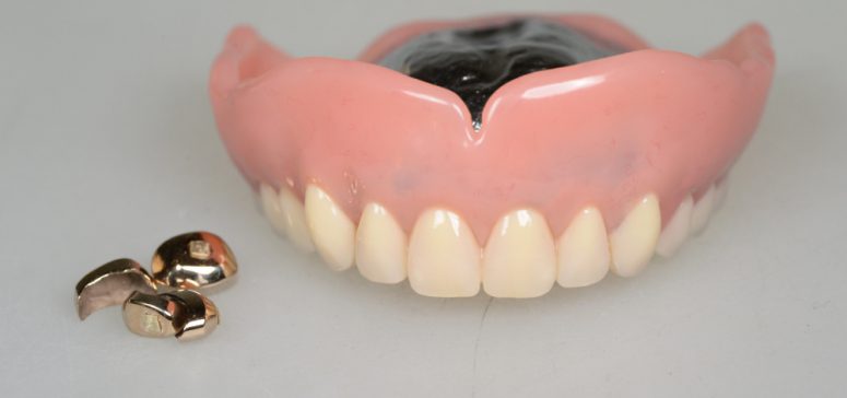 【取り外さない入れ歯】口の中への影響、その他の悪影響はありますか？