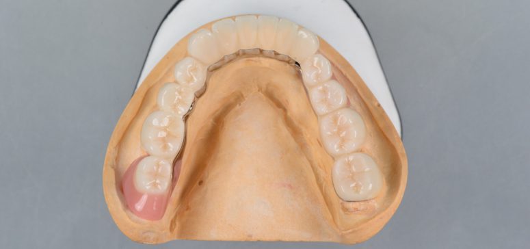 歯周病により下の前歯が抜けてしまった場合の治療方法について