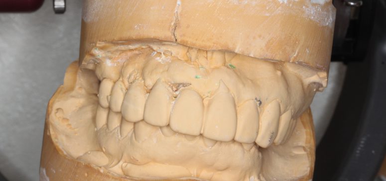 前歯のブリッジが斜めに下がって見える〜原因と治療方法について〜