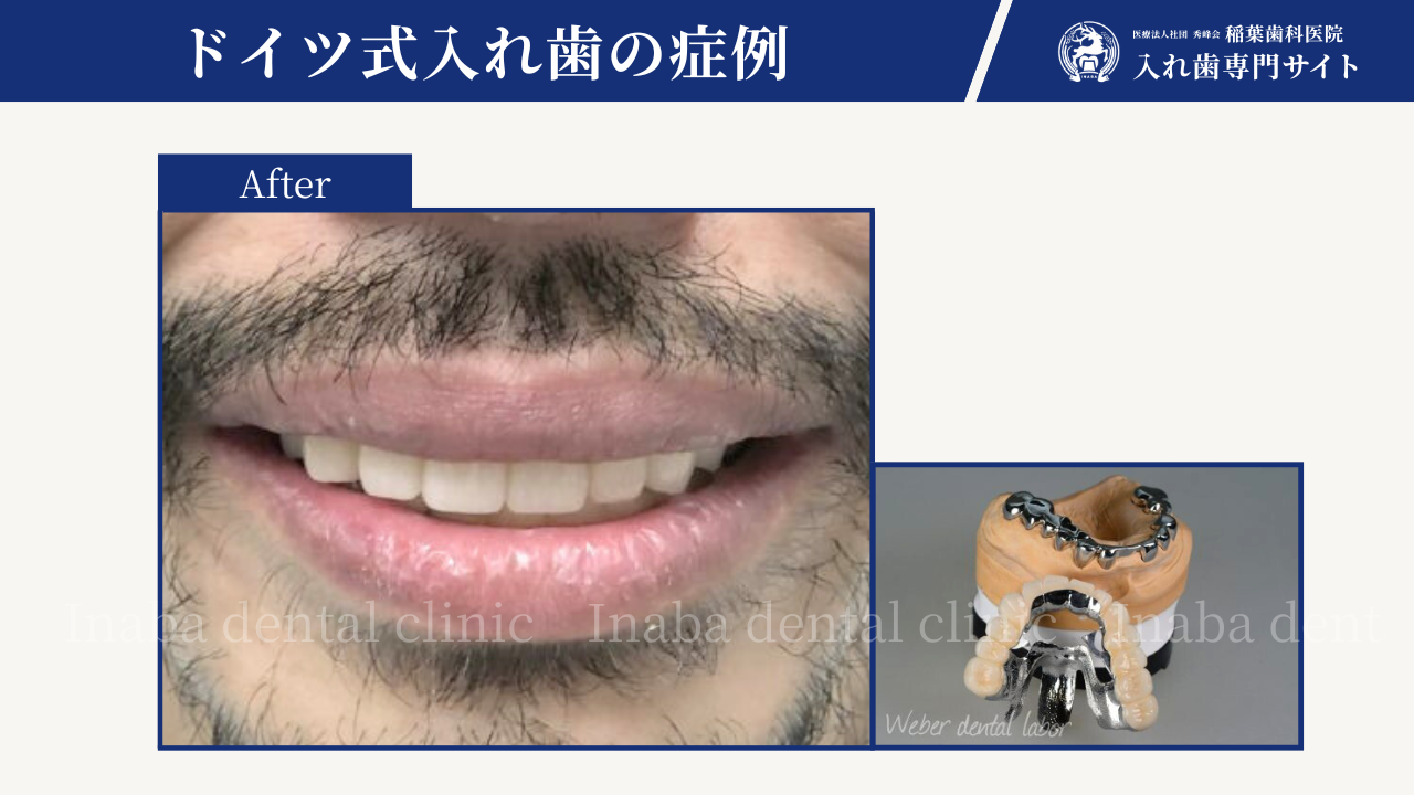 笑った時に上の歯が見えない～ドイツ式入れ歯で治した症例～