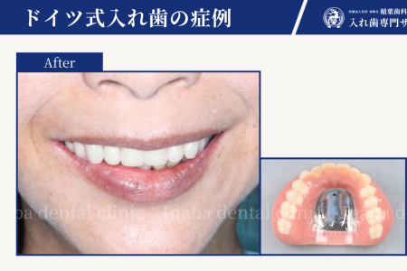 入れ歯の型取りで嘔吐（おうと）反射がある方へ