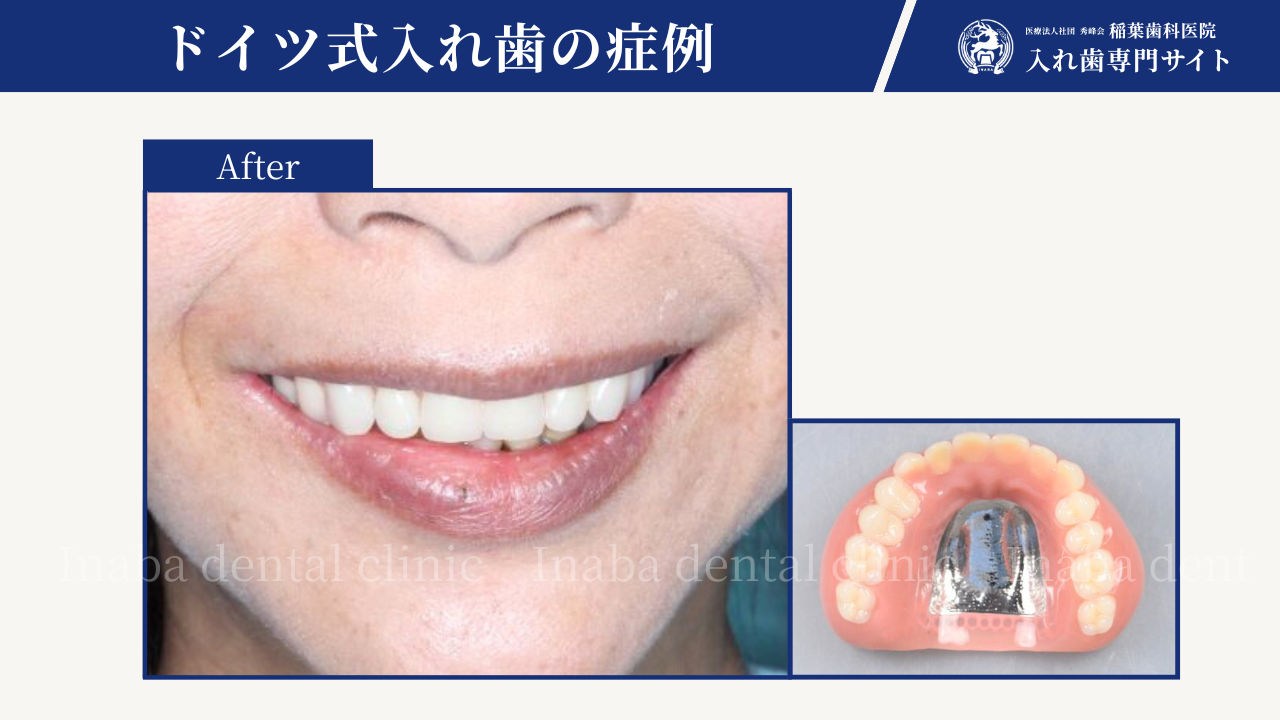 入れ歯の型取りで嘔吐(おうと)反射がある方へ