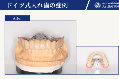 重度歯周病でも抜かずに治療できる方法について