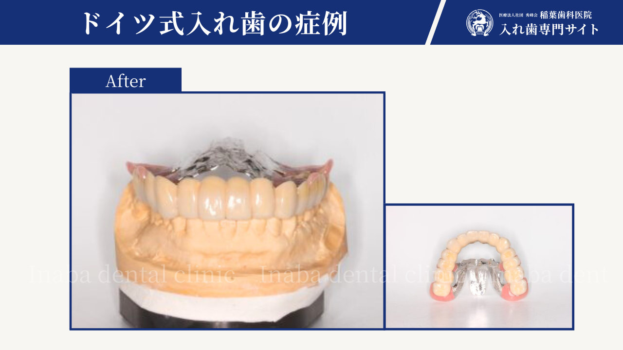 重度歯周病でも抜かずに治療できる方法について