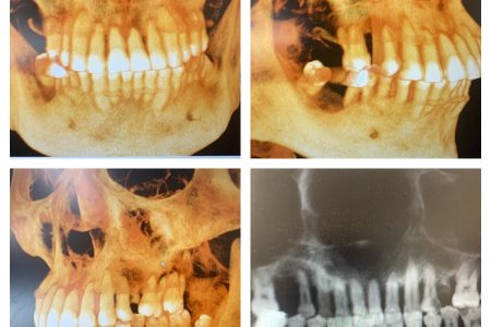 重度歯周病でも抜かずに治療できる方法について