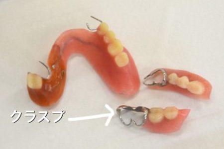 歯周病があり、入れ歯を作るとしたらどのような方法がありますか？