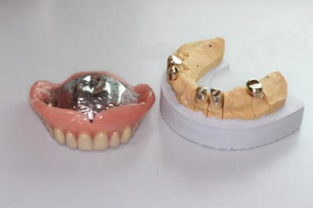 インプラントを入れるか、全ての歯が抜けるのを待って総入れ歯にするか。（50代女性）