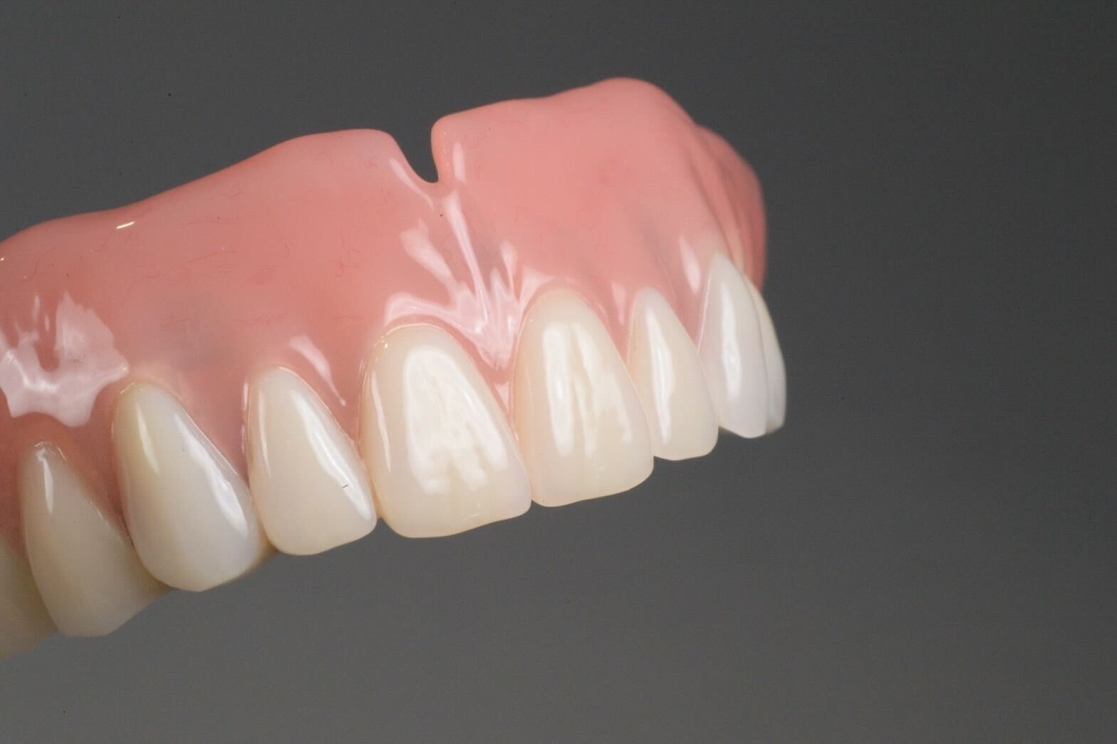 ドイツ式入れ歯 テレスコープ義歯とは？ | 入れ歯専門 千代田区の稲葉