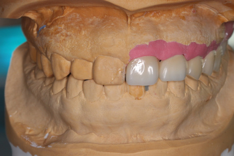 テレスコープ義歯は金属の金具が見えることがありません。