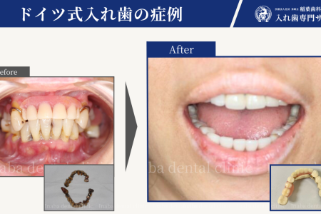 前歯が4本ない場合の治療方法について