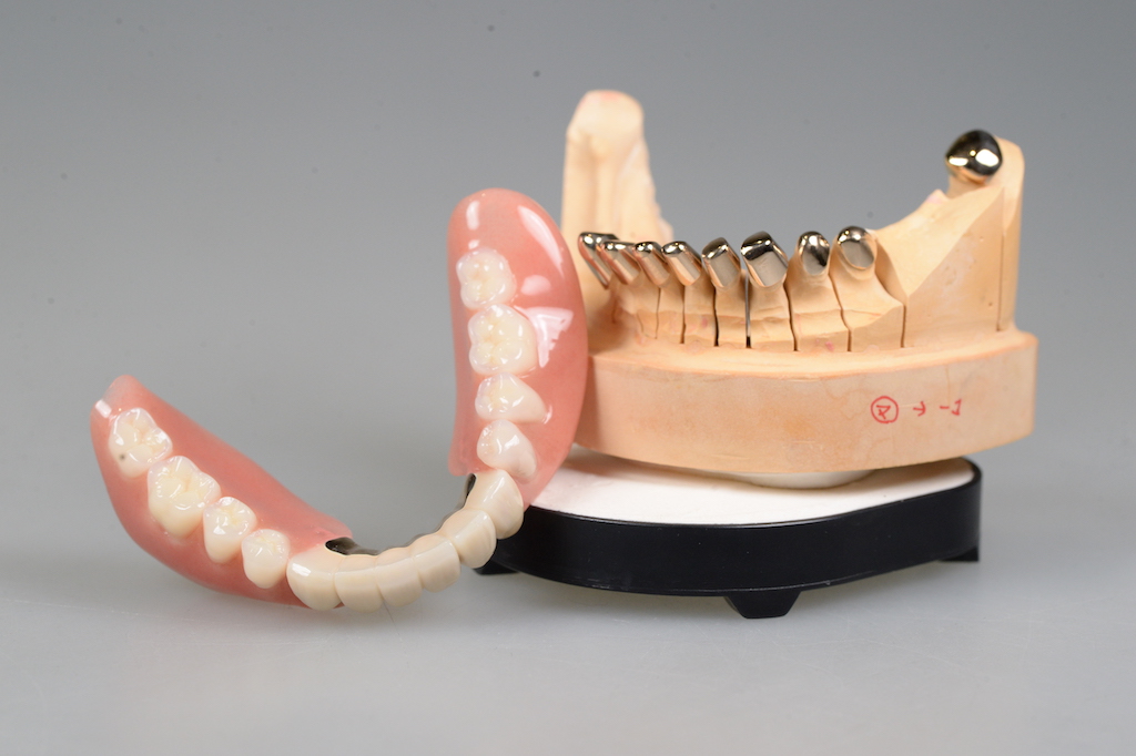 50代、両側奥歯がない〜ドイツ式入れ歯コーヌスクローネ〜 | 東京千代田区の稲葉歯科医院 入れ歯専門サイト