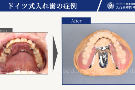 上顎奥歯がほとんどない方へ 〜インプラント以外の治療法！〜