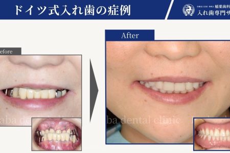 差し歯から入れ歯へ〜受け口の方の入れ歯治療〜（40代女性）