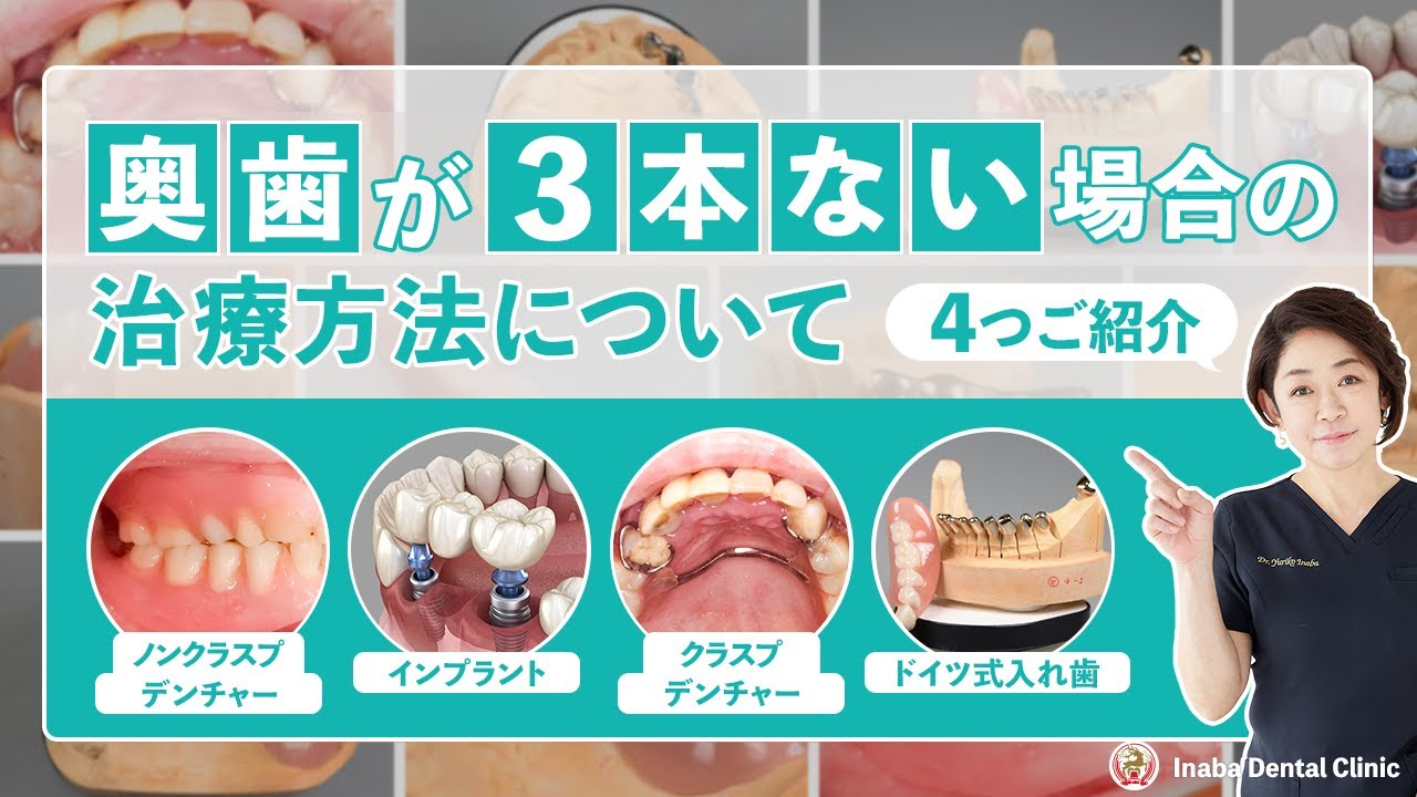 【YouTube】奥歯が3本ない場合の治療方法について4つご紹介