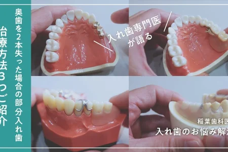 「奥歯を失った場合の部分入れ歯」治療法3つをご紹介