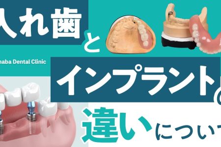 【YouTube】入れ歯とインプラントの違いについて