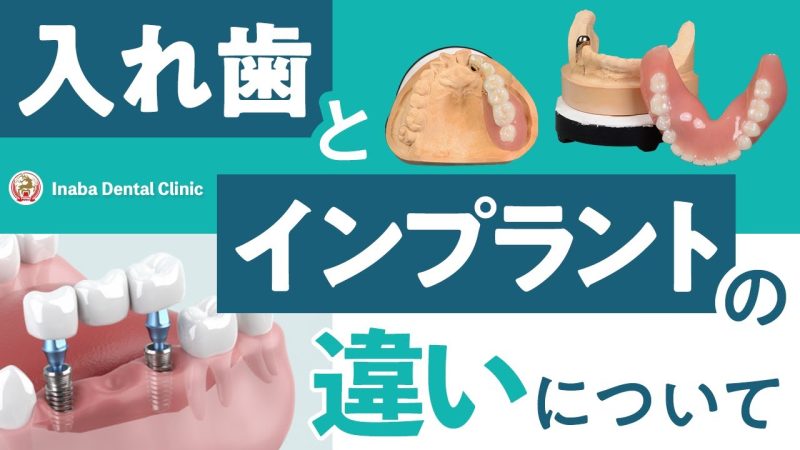 【YouTube】入れ歯とインプラントの違いについて