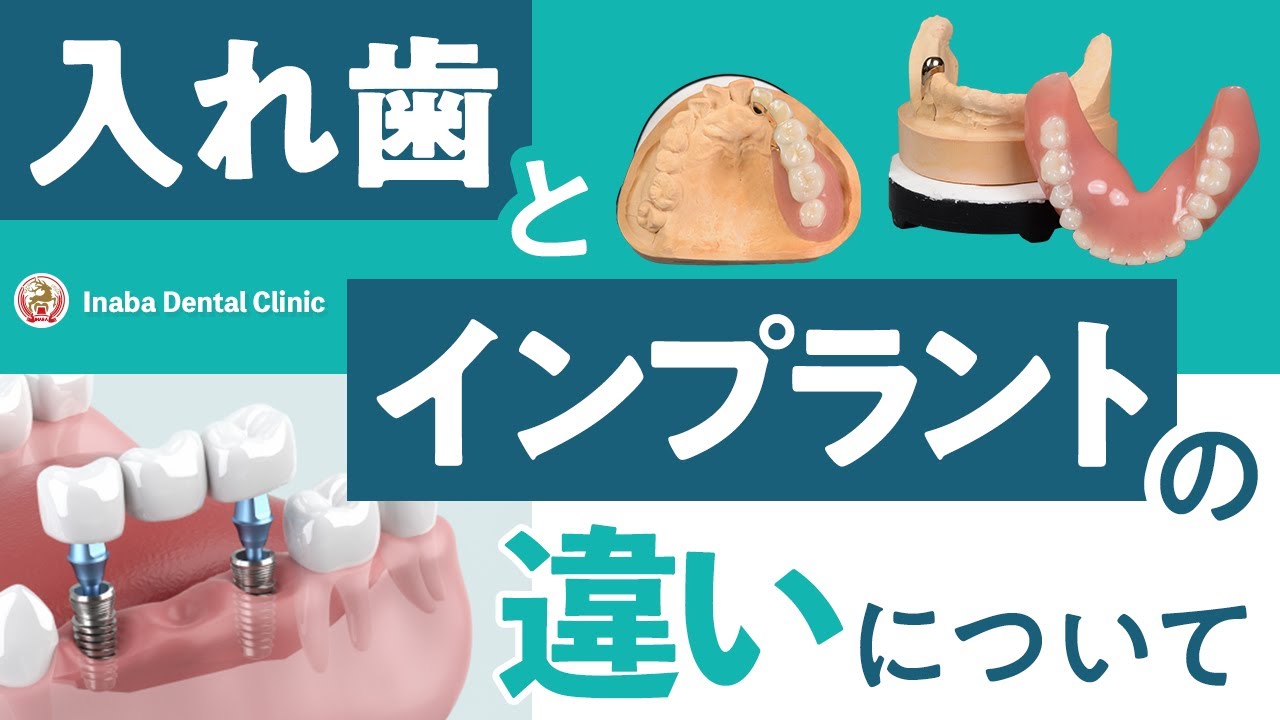 【YouTube】入れ歯とインプラントの違いについて
