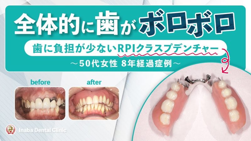 【YouTube】全体的に歯がボロボロ歯に負担の少ないRPIクラスプデンチャー〜50代女性8年経過症例〜
