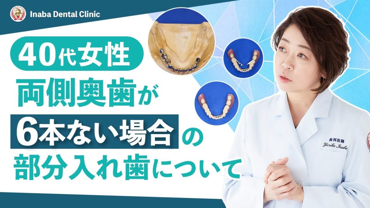 【YouTube】40代女性、両側奥歯が6本ない場合の部分入れ歯について