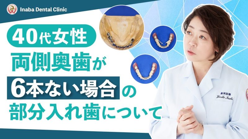 【YouTube】40代女性、両側奥歯が6本ない場合の部分入れ歯について