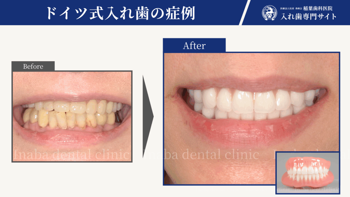 噛める喜びをもう一度〜総入れ歯治療のステップと成功の秘訣〜
