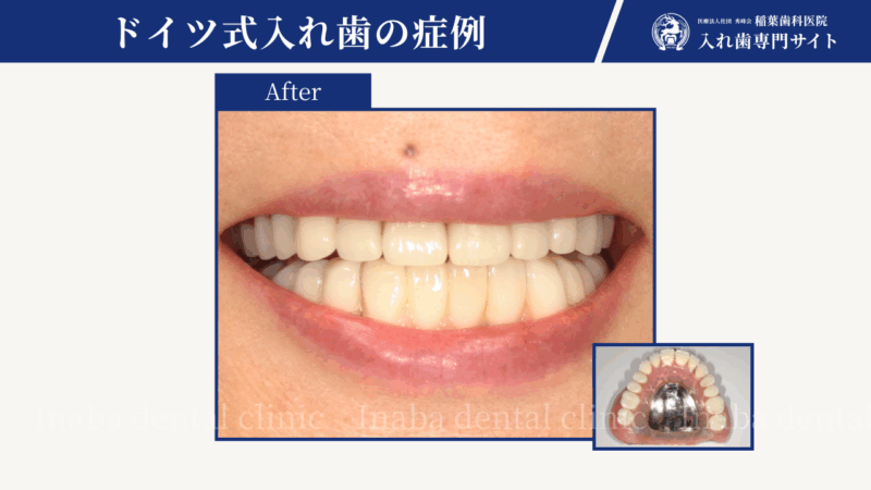 英語スピーチ大会に間に合わせたい〜発音と美しさを取り戻したドイツ式テレスコープ義歯の12年後〜