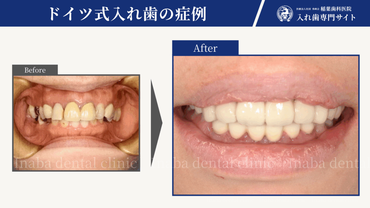 奥歯がなくても噛める選択肢があります～前歯6本で支えるドイツ式入れ歯治療～