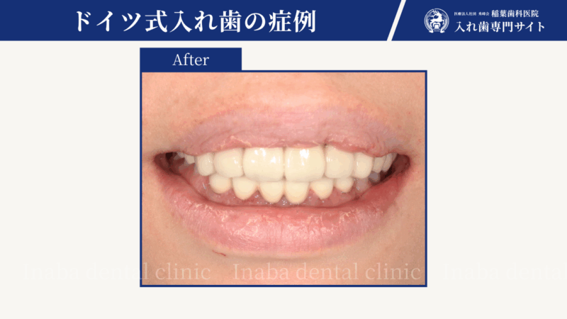 奥歯がなくても噛める選択肢があります~前歯6本で支えるドイツ式入れ歯治療~