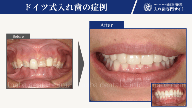 下の歯がない方の治療例~ジルコニアセラミックとドイツ式入れ歯(テレスコープ義歯)の実例紹介~
