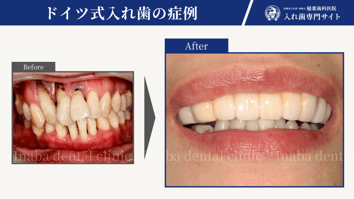 10年経っても1本も歯を失っていない ― ドイツ式入れ歯・リーゲルテレスコープ治療の実例