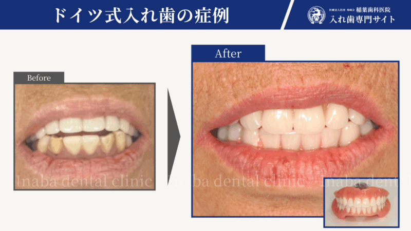 「入れ歯がすぐ外れる…」70代女性　6回の通院でしっかり噛める入れ歯治療