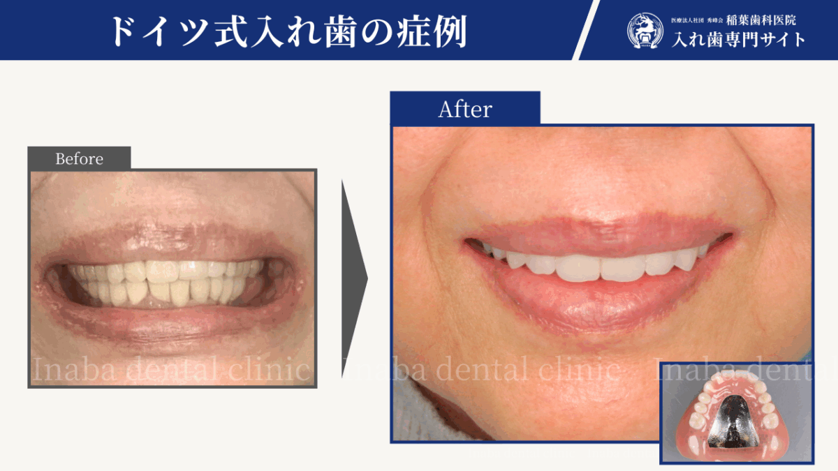 「インプラントを活かす入れ歯治療|リーゲルテレスコープで“噛める喜び”を取り戻した症例」