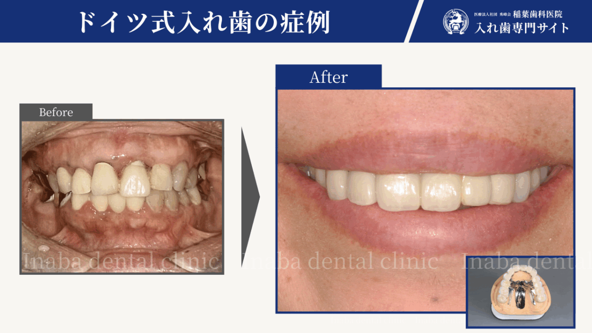 「全部治療した歯なのに噛めない」何度も治療してきたからこそ、丁寧に向き合った1年半