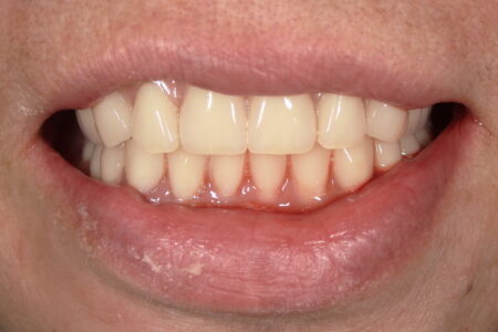総入れ歯の仮歯（即時義歯）とは？抜歯後すぐに入れた72歳女性の体験①