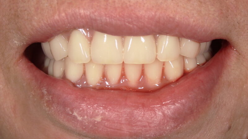 総入れ歯の仮歯（即時義歯）とは？抜歯後すぐに入れた72歳女性の体験①