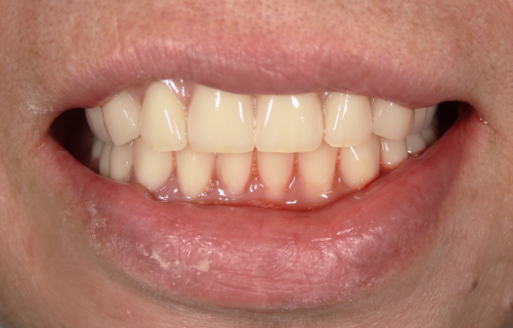 総入れ歯の仮歯（即時義歯）とは？抜歯後すぐに入れた72歳女性の体験①