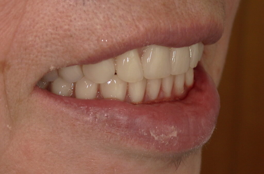 総入れ歯の仮歯は痛い？食べられない時期と慣れるまでの記録②